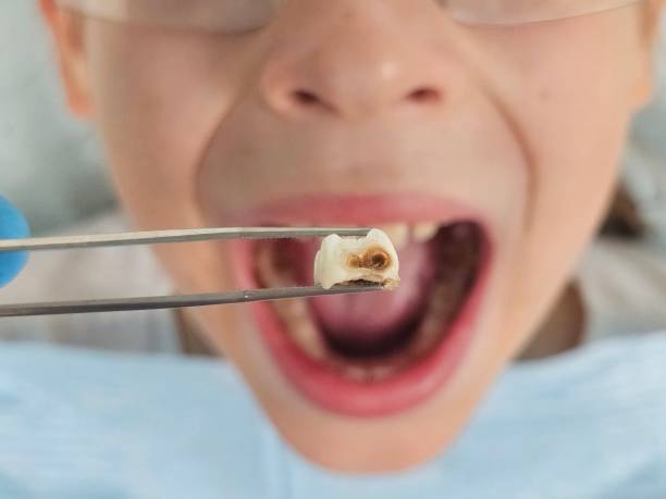 Best Emergency Treatment for Dental Infections or Abscesses in Leachville, AR